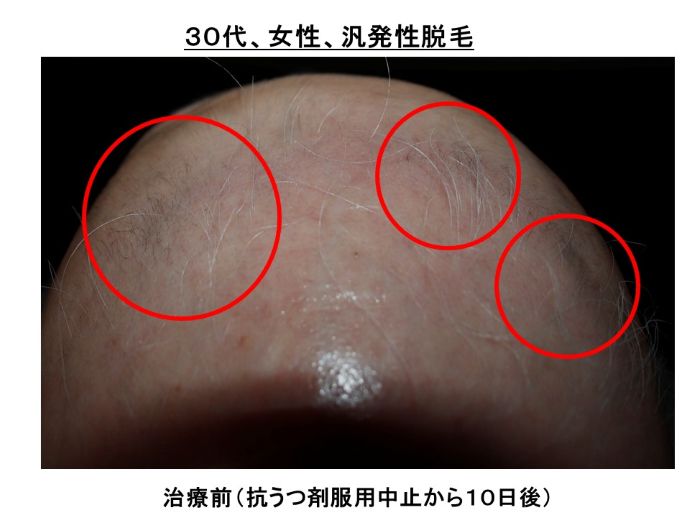円形脱毛症　病院